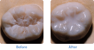 Dental Sealants