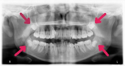 wisdom teeth removal markham, tooth extraction markham