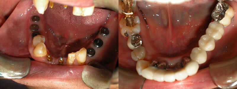 dental implants markham