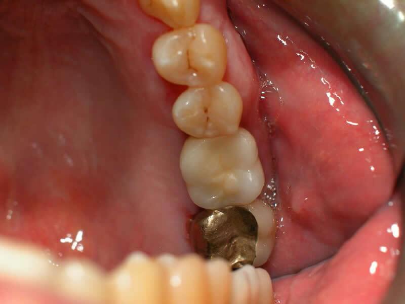 Dental Implants