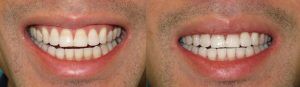 Teeth Whitening