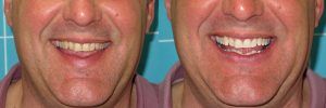 teeth whitening markham