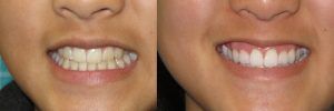 Teeth Whitening