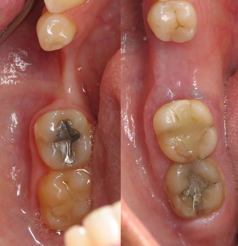 bone graft