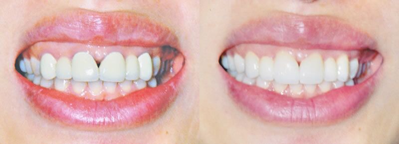 Veneers