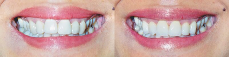 Veneers