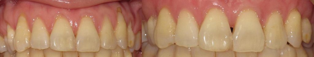 Gum Graft