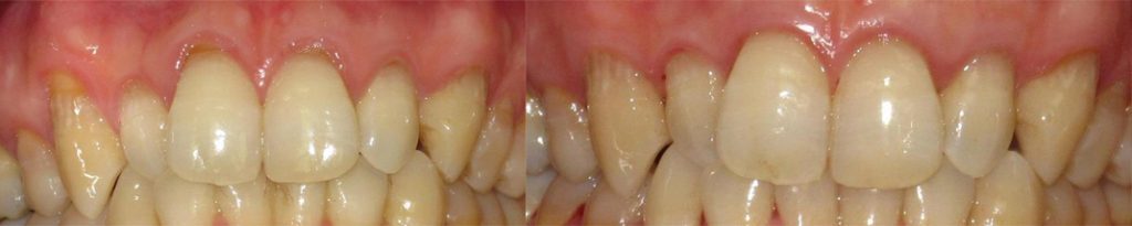 Gum Graft