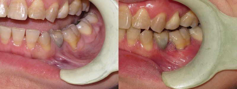 Gum Graft