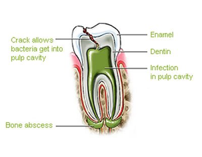root canal 