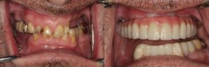 7-intra-oral-before-and-after